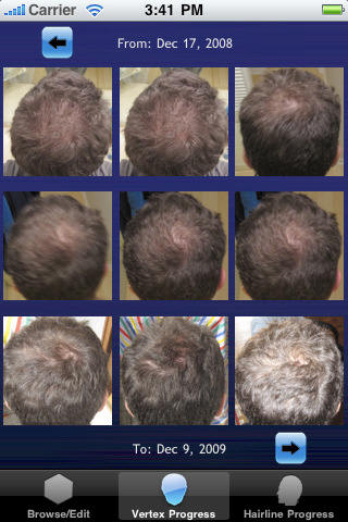 hair loss app